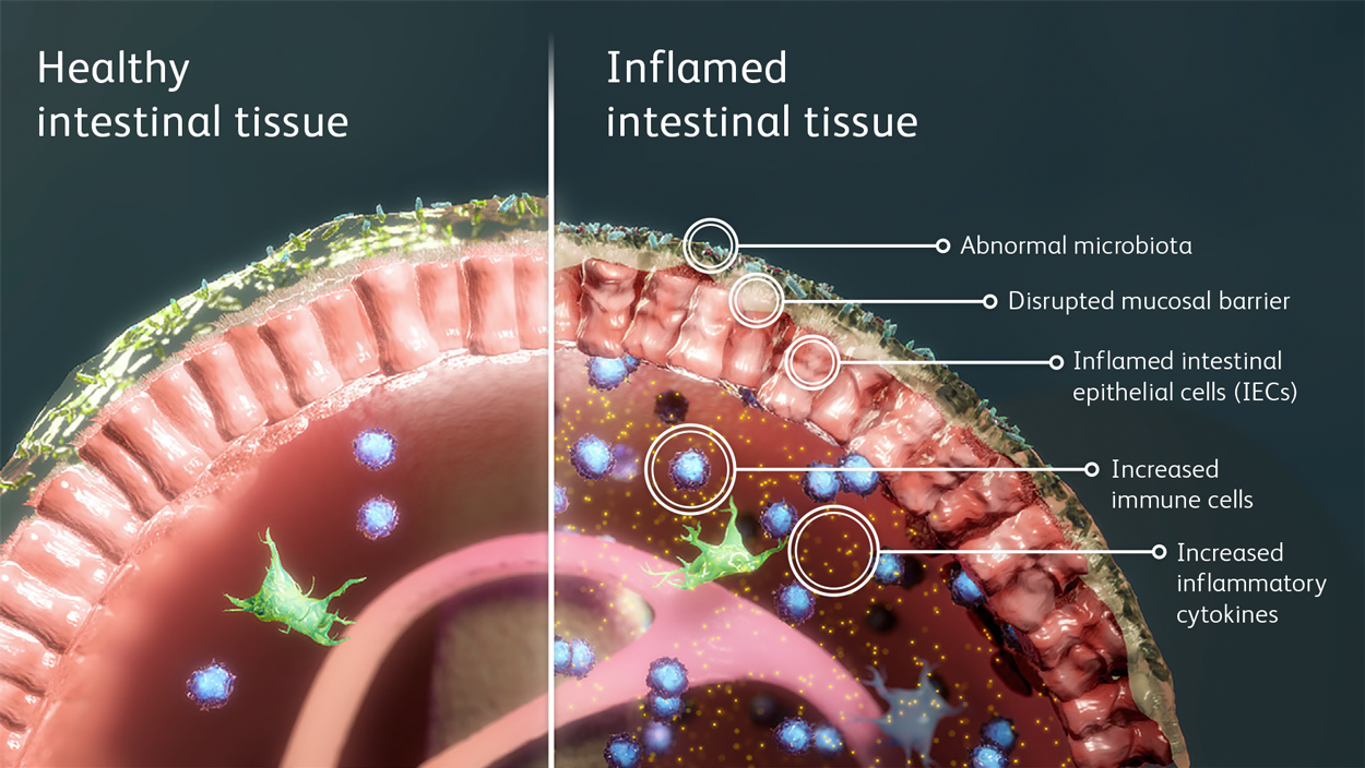 The Gut’s Immune System